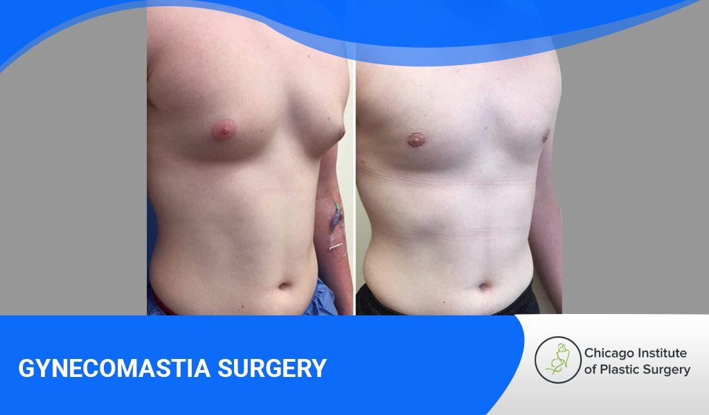 What Men Should Know Before Having Gynecomastia Surgery